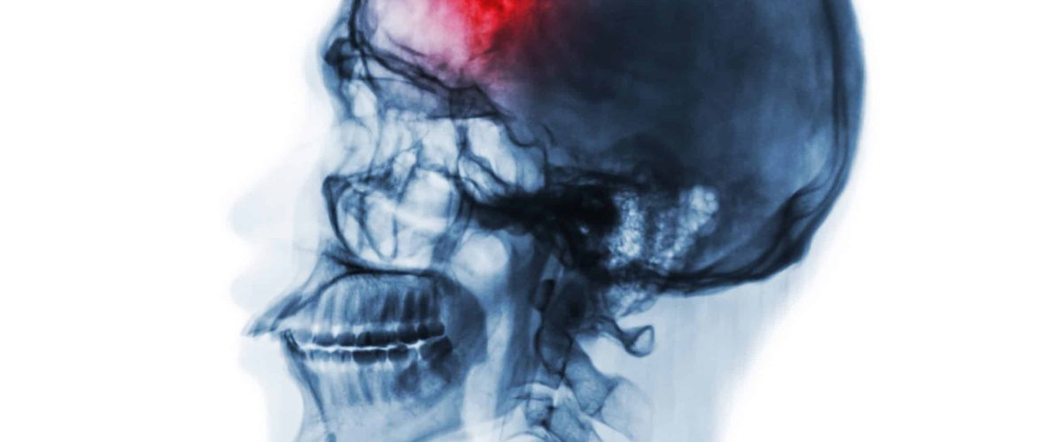 Stroke . Cerebrovascular accident . Film x-ray of human skull and cervical spine .